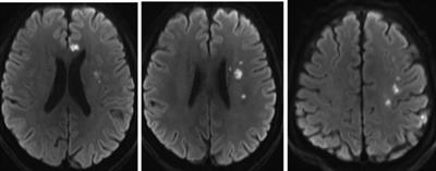 Hypoperfusion cerebral infarction after carotid artery stenting: A case report